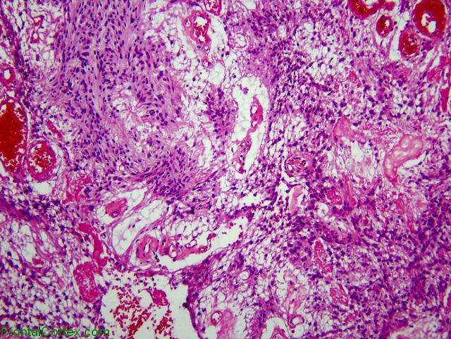 Myxopapillary ependymoma, H. and E. stain x200